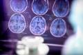 Researchers find a possible new cause for Alzheimer’s disease