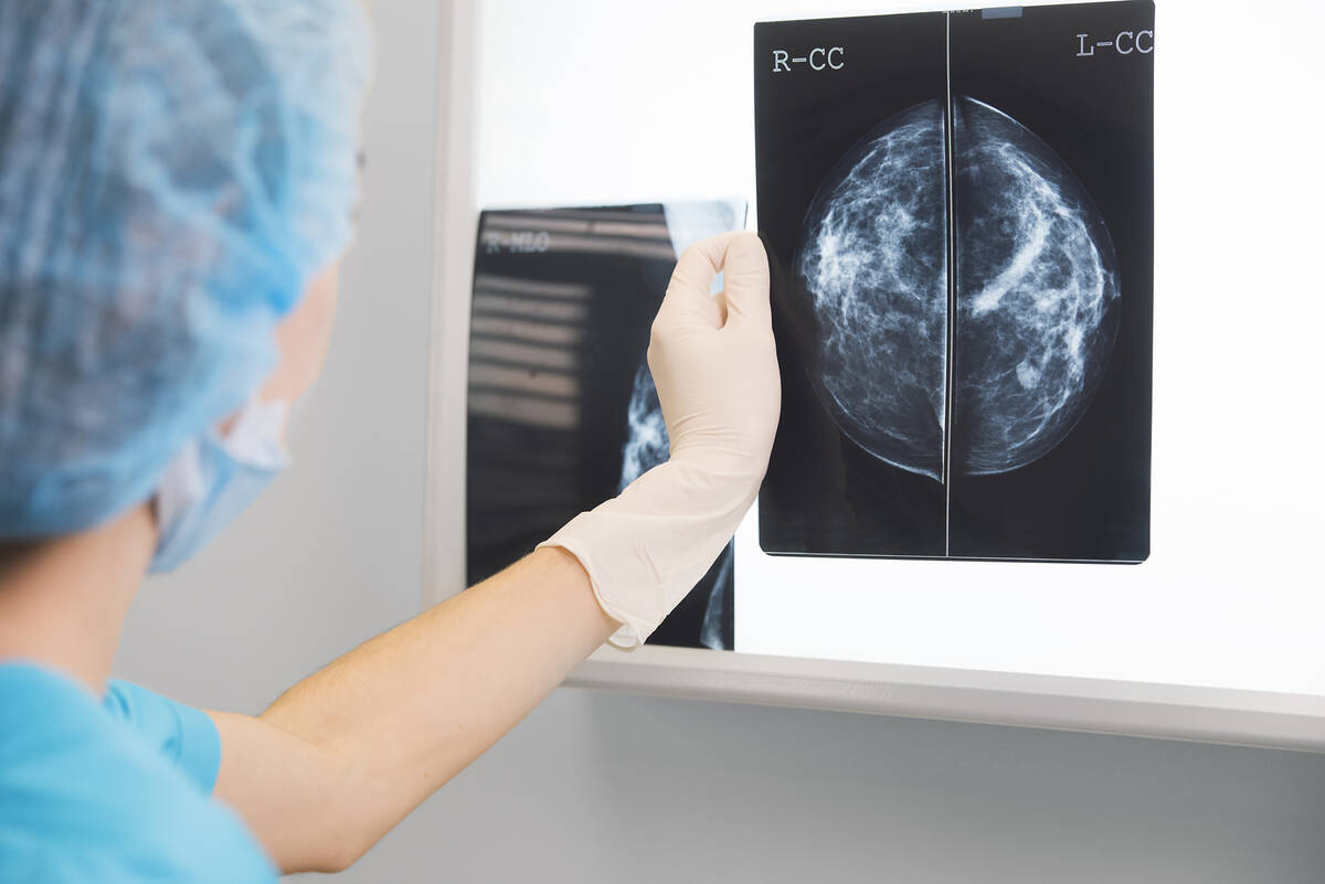 “I advise all patients to consider starting annual screening mammography beginning at ag ...