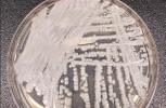 Fungus ‘superbug’ cases rise to highest levels in Nevada