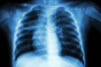 No known additional active tuberculosis cases have developed — so far — from a person with ...