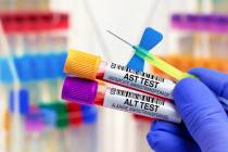 The only way to know if someone's levels of liver enzymes, types of proteins mainly called AST ...