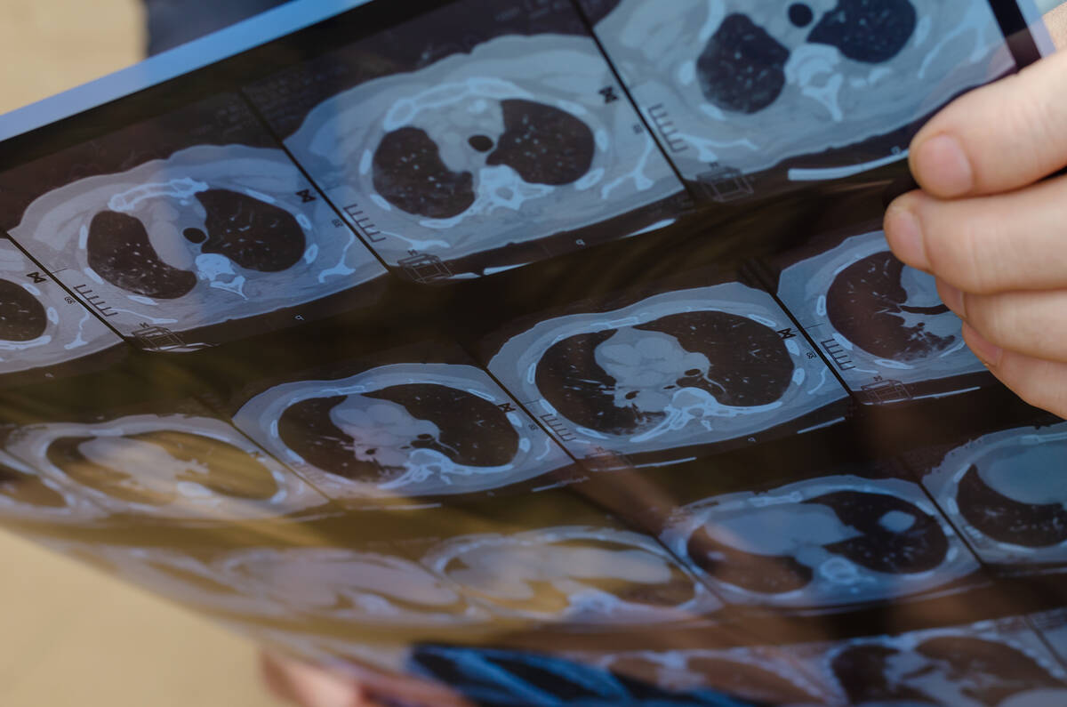 Though guidelines vary, cardiologists generally offer statins to patients with calcium scores o ...
